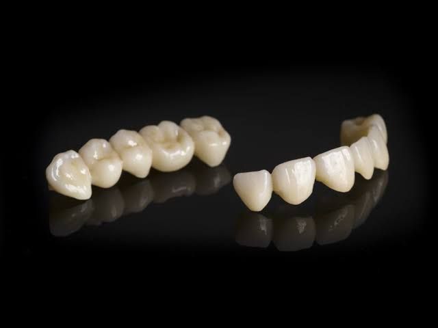 Dental bridge