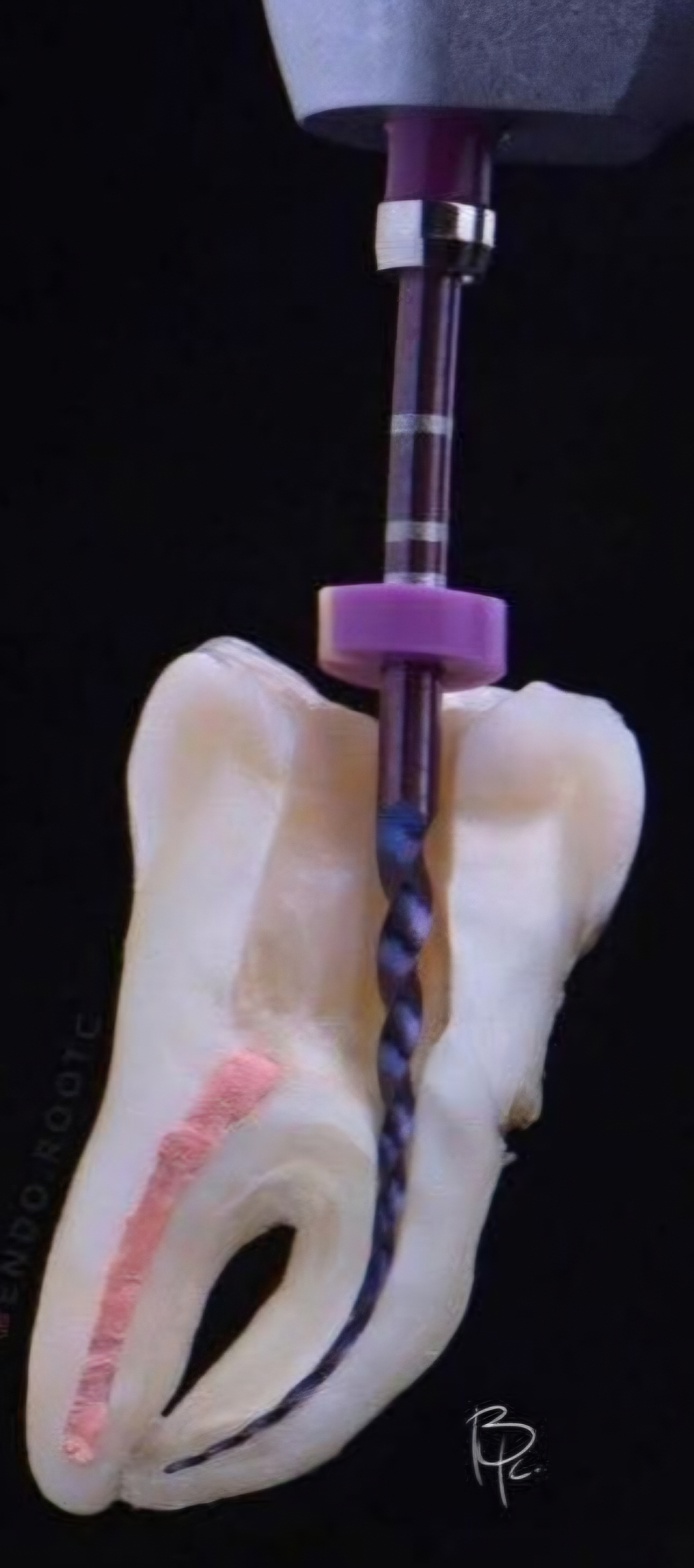 Root canal treatment