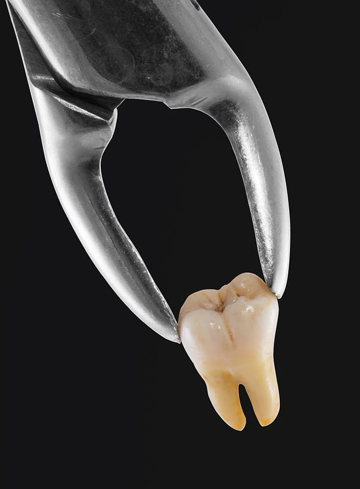 Tooth extraction