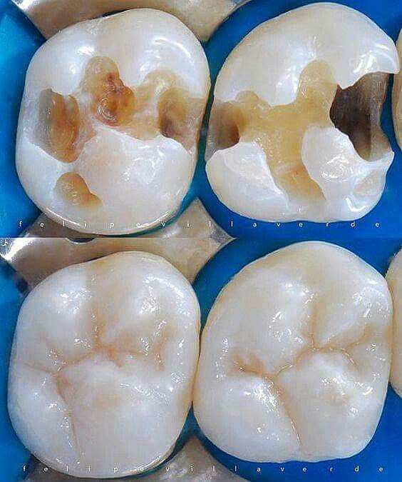 Cavity fillings before and after