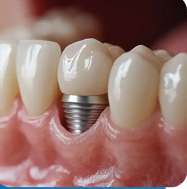 Dental implant