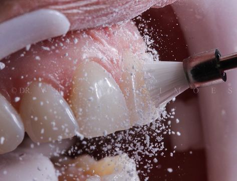 Professional dental cleaning