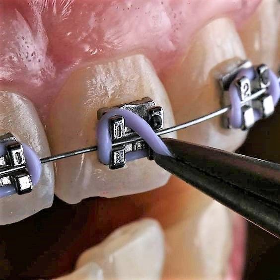 Orthodontic braces