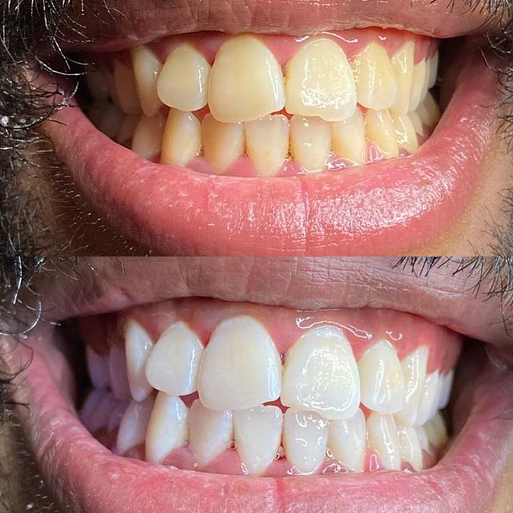 Teeth whitening before and after